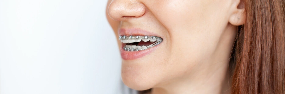Дистальный прикус: что это, последствия и современные методы лечения в Brillant Dental